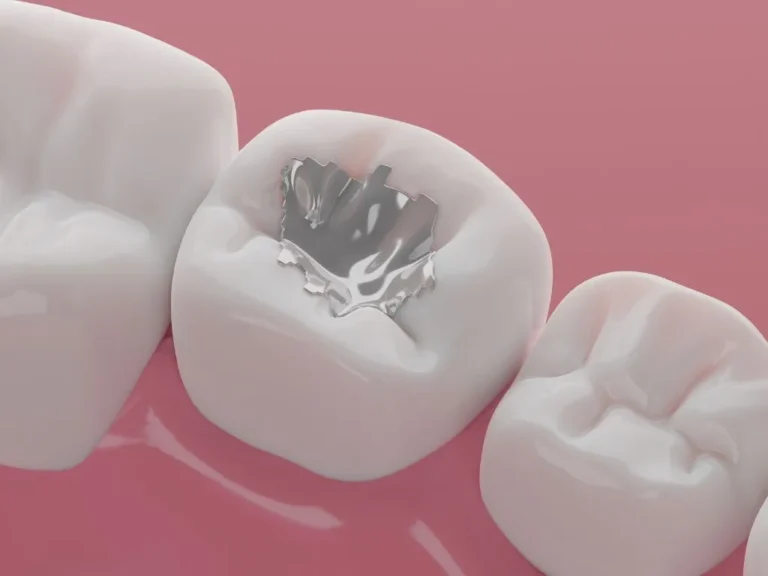 Amalgam-Free Dentistry at Prairie Winds Dental